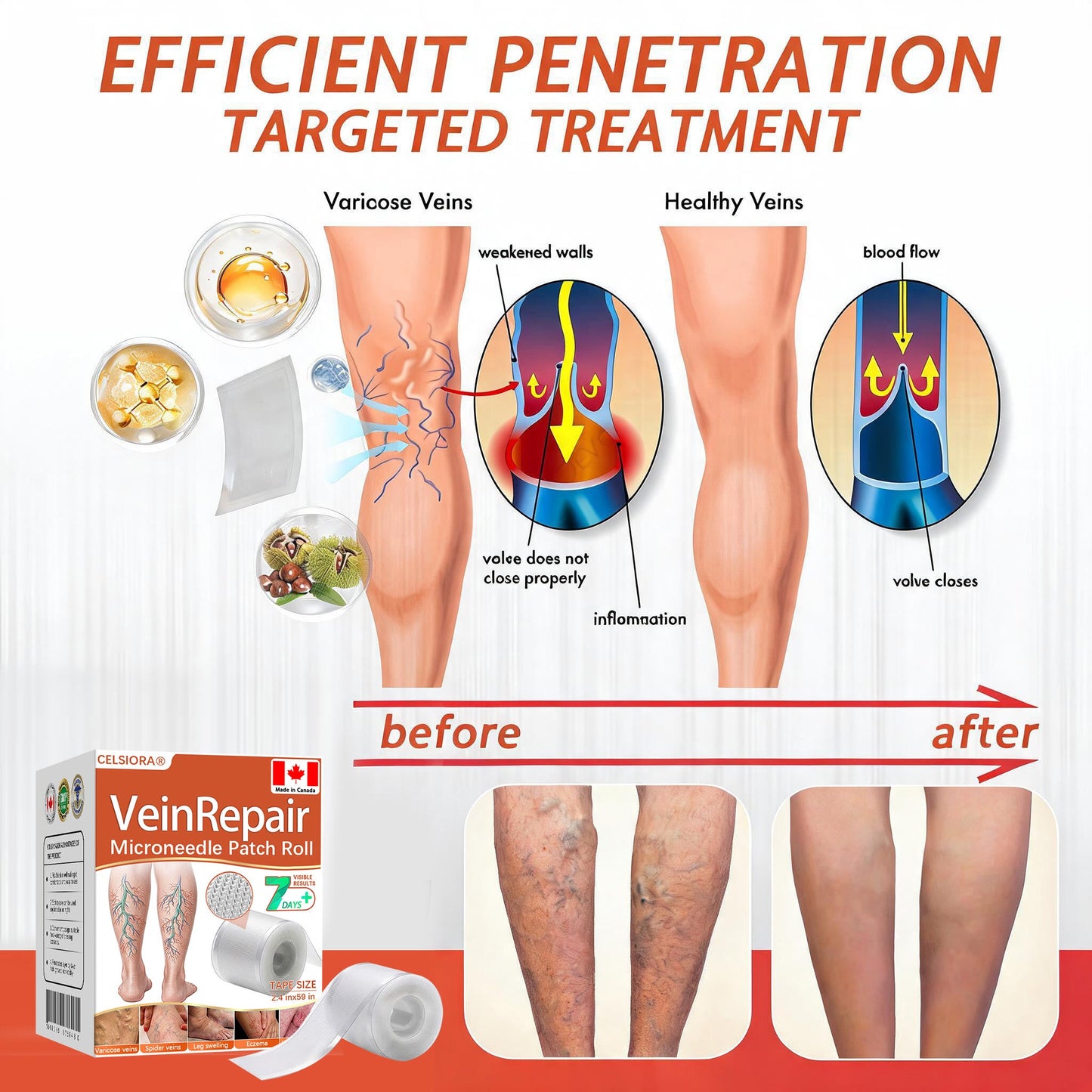 🍁 Official CA Store 🇨🇦 | Celsiora® Vein Ease Microneedle Care Patch(For Spider Veins, Varicose Veins, Swelling & Leg Fatigue) - Last Day Promotion 50% OFF