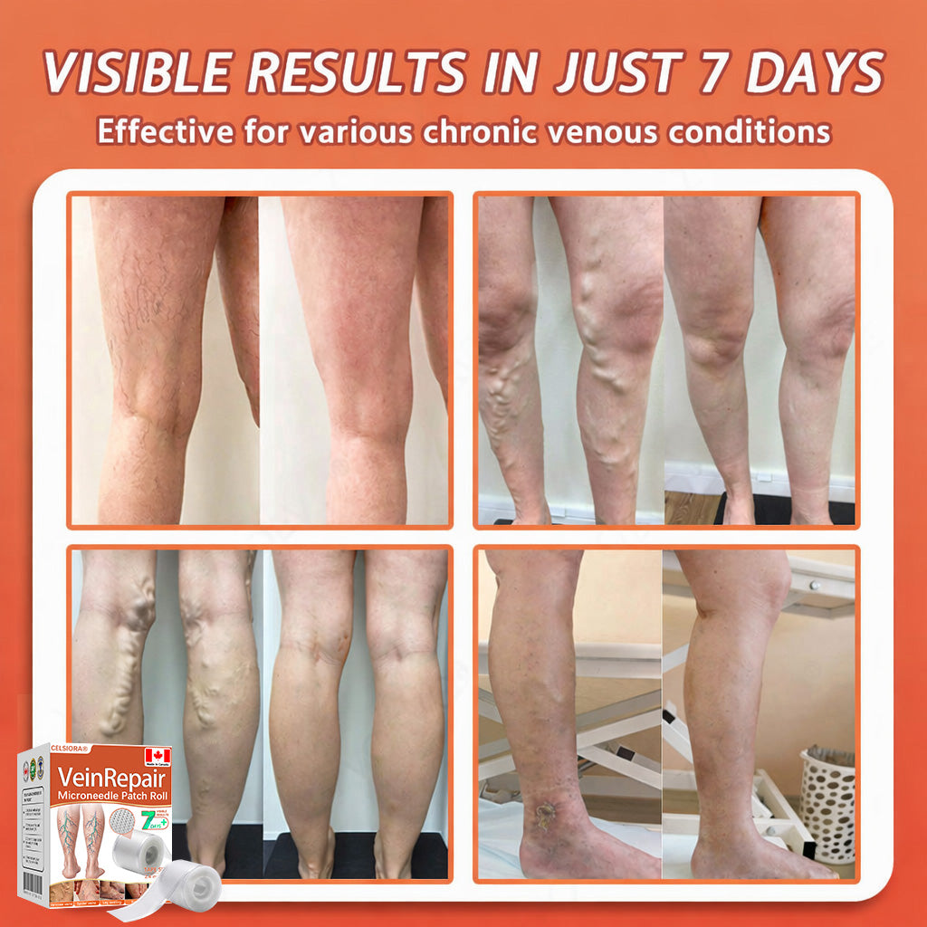🍁 Official CA Store 🇨🇦 | Celsiora® Vein Ease Microneedle Care Patch(For Spider Veins, Varicose Veins, Swelling & Leg Fatigue) - Last Day Promotion 50% OFF