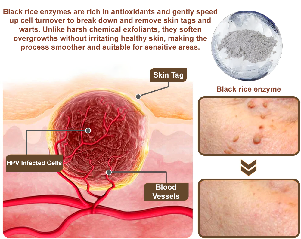 50% Discount Zvoevo® Black Rice Skin Repair Essence Cream 👨‍⚕️ MHRA Certified (Eliminates warts and skin tags, relieves psoriasis, improves keratin build-up and follicular keratinization, fades pigmentation, sun spots & age spots)