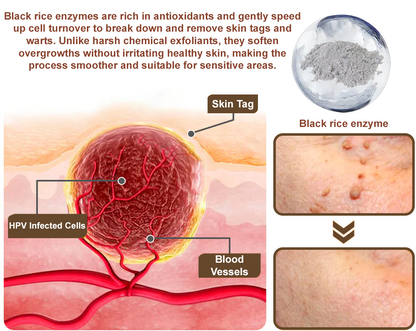 50% Discount Zvoevo® Black Rice Skin Repair Essence Cream 👨‍⚕️ MHRA Certified (Eliminates warts and skin tags, relieves psoriasis, improves keratin build-up and follicular keratinization, fades pigmentation, sun spots & age spots)