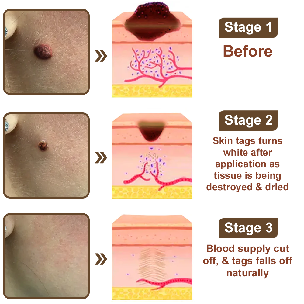 50% Discount Zvoevo® Black Rice Skin Repair Essence Cream 👨‍⚕️ MHRA Certified (Eliminates warts and skin tags, relieves psoriasis, improves keratin build-up and follicular keratinization, fades pigmentation, sun spots & age spots)