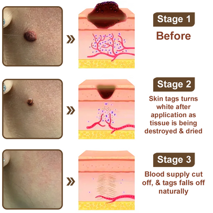 50% Discount Zvoevo® Black Rice Skin Repair Essence Cream 👨‍⚕️ MHRA Certified (Eliminates warts and skin tags, relieves psoriasis, improves keratin build-up and follicular keratinization, fades pigmentation, sun spots & age spots)