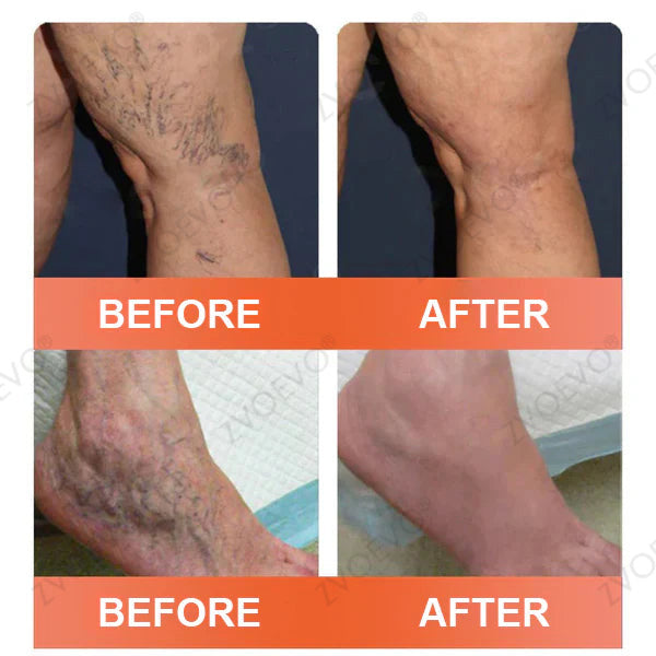 🍁 Official CA Store 🇨🇦 | Celsiora® Vein Ease Microneedle Care Patch(For Spider Veins, Varicose Veins, Swelling & Leg Fatigue) - Last Day Promotion 50% OFF
