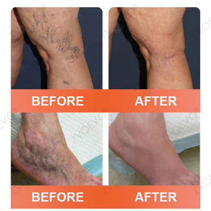 🍁 Official CA Store 🇨🇦 | Celsiora® Vein Ease Microneedle Care Patch(For Spider Veins, Varicose Veins, Swelling & Leg Fatigue) - Last Day Promotion 50% OFF