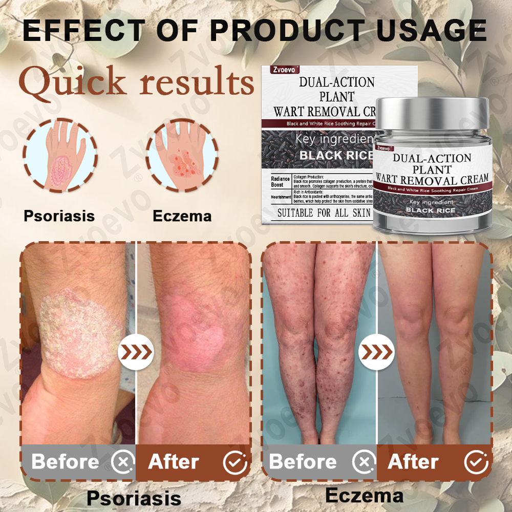 50% Discount Zvoevo® Black Rice Skin Repair Essence Cream 👨‍⚕️ MHRA Certified (Eliminates warts and skin tags, relieves psoriasis, improves keratin build-up and follicular keratinization, fades pigmentation, sun spots & age spots)