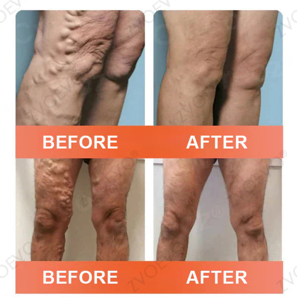 🍁 Official CA Store 🇨🇦 | Celsiora® Vein Ease Microneedle Care Patch(For Spider Veins, Varicose Veins, Swelling & Leg Fatigue) - Last Day Promotion 50% OFF
